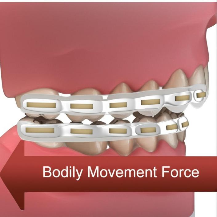 Long horizontal buccal attachment with three-sided aligner channel showing bodily movement force